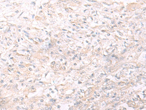 Immunohistochemistry of paraffin-embedded Human liver cancer tissue  using IL26 Polyclonal Antibody at dilution of 1:65(?200)