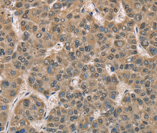 Immunohistochemistry of paraffin-embedded Human liver cancer tissue using DACH2 Polyclonal Antibody at dilution 1:40