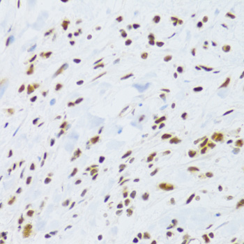 Immunohistochemistry of paraffin-embedded Human gastric cancer using DDB1 Polyclonal Antibody at dilution of  1:100 (40x lens).