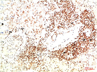 Immunohistochemistry of paraffin-embedded Human lung carcinoma tissue using JAK2 Monoclonal Antibody at dilution of 1:200.