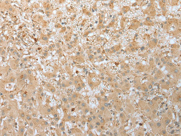 Immunohistochemistry of paraffin-embedded Human liver cancer tissue  using FNDC3B Polyclonal Antibody at dilution of 1:45(?200)