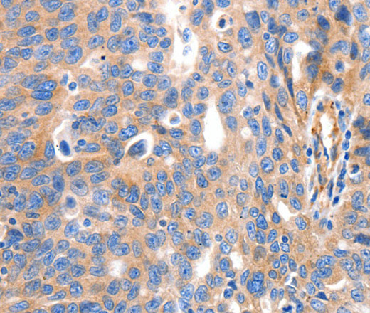 Immunohistochemistry of paraffin-embedded Human ovarian cancer tissue using IGFBP7 Polyclonal Antibody at dilution 1:50