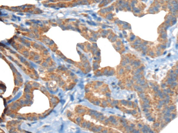 Immunohistochemistry of paraffin-embedded Human thyroid cancer tissue  using RTN4IP1 Polyclonal Antibody at dilution of 1:50(?200)