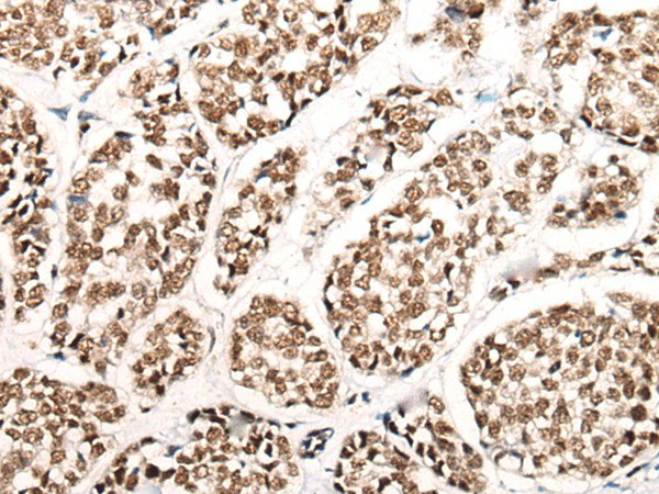 Immunohistochemistry of paraffin-embedded Human esophagus cancer tissue  using HGH1 Polyclonal Antibody at dilution of 1:45(?200)