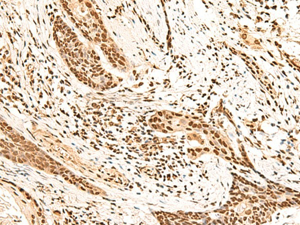 Immunohistochemistry of paraffin-embedded Human esophagus cancer tissue  using HOXC13 Polyclonal Antibody at dilution of 1:60(?200)