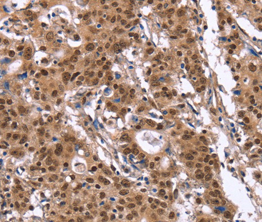 Immunohistochemistry of paraffin-embedded Human gasrtic cancer tissue using ID4 Polyclonal Antibody at dilution 1:40