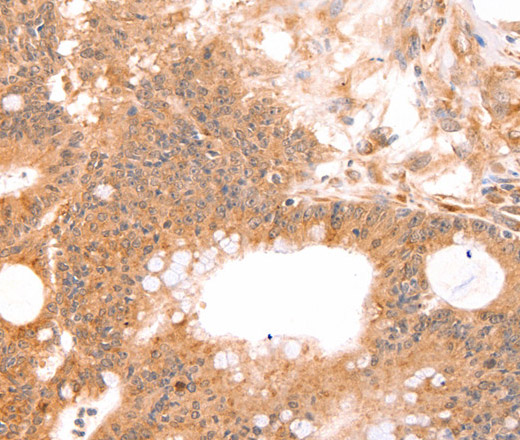 Immunohistochemistry of paraffin-embedded Human colon cancer tissue using TNF beta Polyclonal Antibody at dilution 1:50