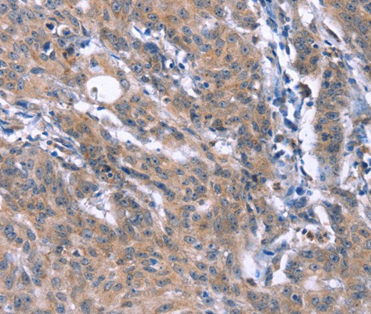 Immunohistochemistry of paraffin-embedded Human gasrtic cancer tissue using ESPL1 Polyclonal Antibody at dilution 1:40