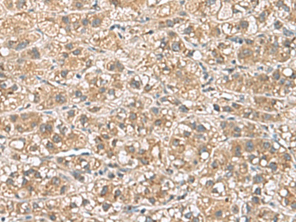 Immunohistochemistry of paraffin-embedded Human liver cancer tissue  using PHLDA3 Polyclonal Antibody at dilution of 1:110(?200)