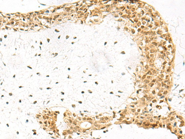 Immunohistochemistry of paraffin-embedded Human breast cancer tissue  using EXOSC4 Polyclonal Antibody at dilution of 1:70(?200)