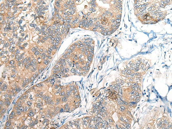 Immunohistochemistry of paraffin-embedded Human gastric cancer tissue  using BCAN Polyclonal Antibody at dilution of 1:35(?200)