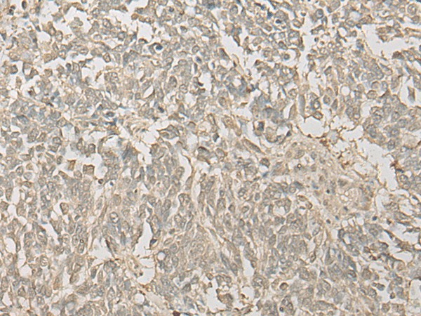 Immunohistochemistry of paraffin-embedded Human lung cancer tissue  using FYTTD1 Polyclonal Antibody at dilution of 1:30(?200)