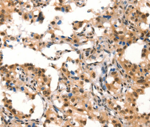 Immunohistochemistry of paraffin-embedded Human thyroid cancer tissue using CUL4B Polyclonal Antibody at dilution 1:50