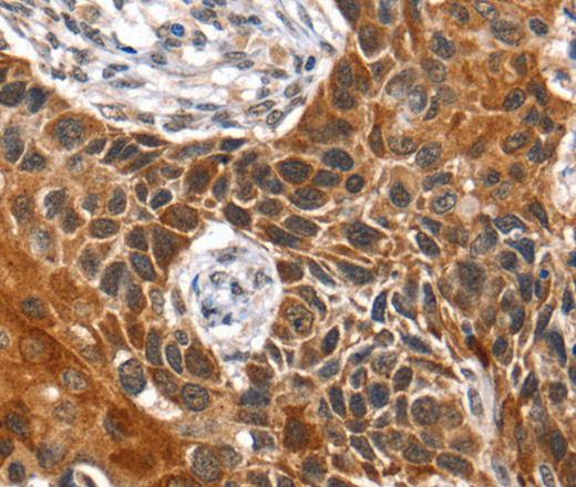 Immunohistochemistry of paraffin-embedded Human esophagus cancer tissue using HOXB1 Polyclonal Antibody at dilution 1:40