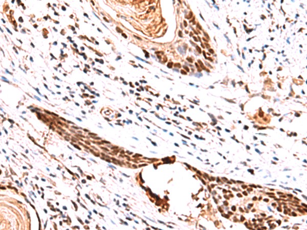 Immunohistochemistry of paraffin-embedded Human esophagus cancer tissue  using IRF2BP1 Polyclonal Antibody at dilution of 1:30(?200)