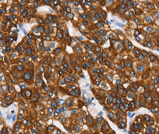 Immunohistochemistry of paraffin-embedded Human liver cancer tissue using CK-8 Polyclonal Antibody at dilution 1:40