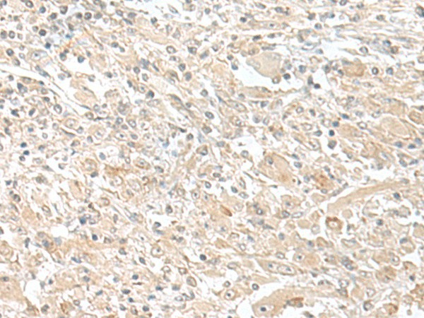 Immunohistochemistry of paraffin-embedded Human liver cancer tissue  using SMS Polyclonal Antibody at dilution of 1:50(?200)