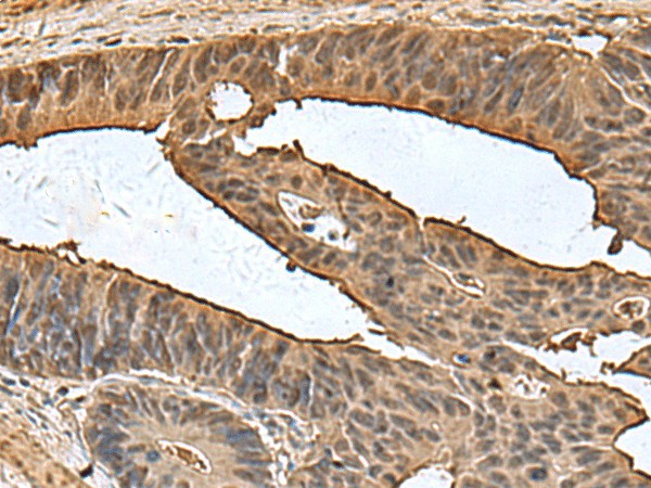 Immunohistochemistry of paraffin-embedded Human colorectal cancer tissue  using DCTPP1 Polyclonal Antibody at dilution of 1:80(?200)