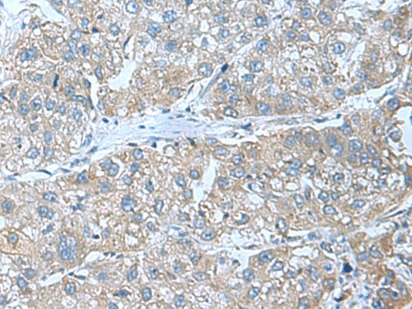 Immunohistochemistry of paraffin-embedded Human liver cancer tissue  using SRPK2 Polyclonal Antibody at dilution of 1:55(?200)