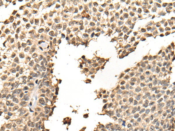 Immunohistochemistry of paraffin-embedded Human ovarian cancer tissue  using BATF Polyclonal Antibody at dilution of 1:40(?200)