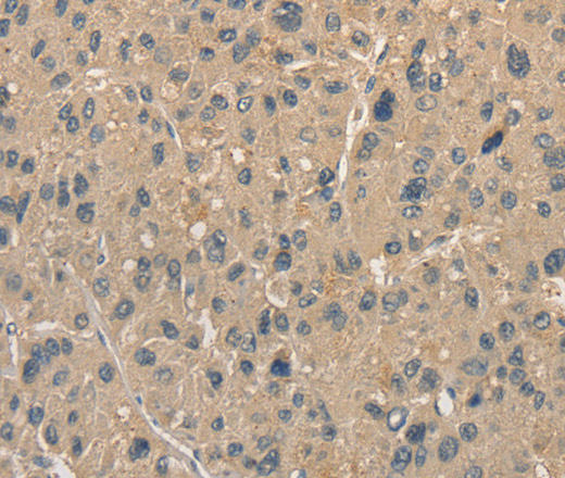 Immunohistochemistry of paraffin-embedded Human liver cancer using ALDH8A1 Polyclonal Antibody at dilution of 1:40