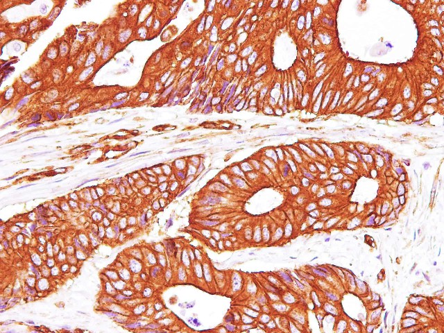 Immunohistochemistry of paraffin-embedded Human carcinoma of Colon using Sptan1 Polyclonal Antibody at dilution of 1:100 (400 x)