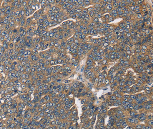 Immunohistochemistry of paraffin-embedded Human cervical cancer using HSD17B12 Polyclonal Antibody at dilution of 1:30