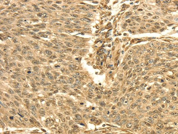 Immunohistochemistry of paraffin-embedded Human lung cancer using SEPT2 Polyclonal Antibody at dilution of  1/30