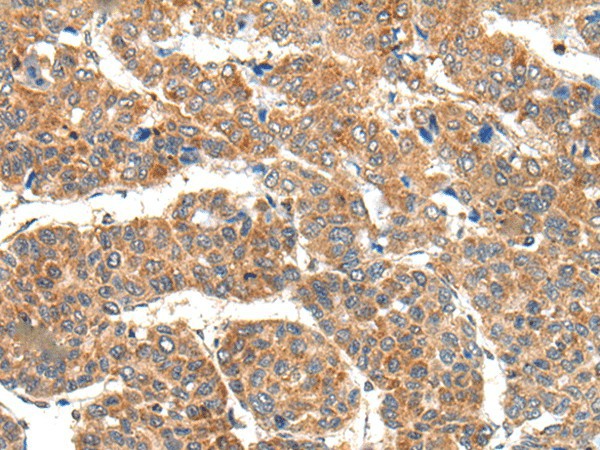 Immunohistochemistry of paraffin-embedded Human liver cancer tissue  using RPL14 Polyclonal Antibody at dilution of 1:30(?200)