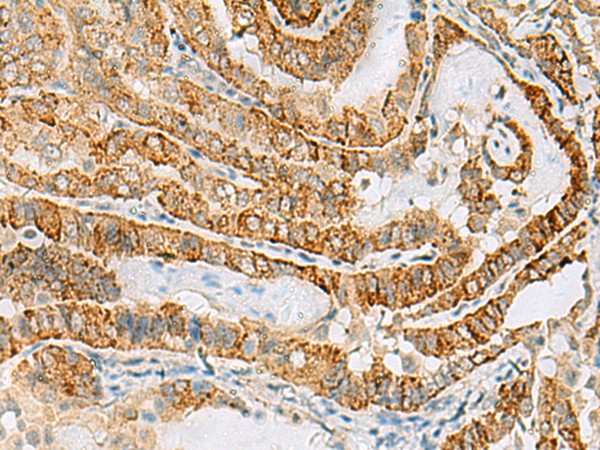 Immunohistochemistry of paraffin-embedded Human thyroid cancer tissue  using FARP2 Polyclonal Antibody at dilution of 1:70(?200)