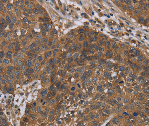 Immunohistochemistry of paraffin-embedded Human lung cancer tissue using OXTR Polyclonal Antibody at dilution 1:40