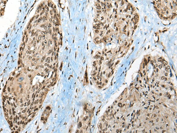 Immunohistochemistry of paraffin-embedded Human esophagus cancer tissue  using CCDC12 Polyclonal Antibody at dilution of 1:50(?200)