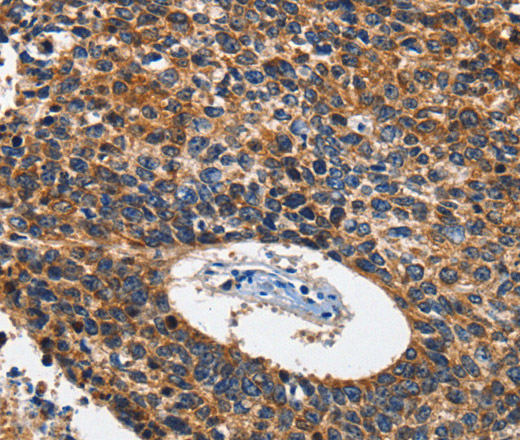 Immunohistochemistry of paraffin-embedded Human lung cancer using HK2 Polyclonal Antibody at dilution of 1:60