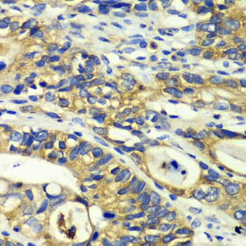 Immunohistochemistry of paraffin-embedded Human colon carcinoma using RPH3A Polyclonal Antibody at dilution of 1:100 (40x lens).