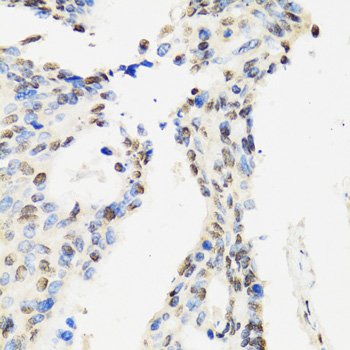 Immunohistochemistry of paraffin-embedded human rectal cancer using CCAR2 Polyclonal antibody at dilution of 1:100 (40x lens).Perform microwave antigen retrieval with 10 mM PBS buffer pH 7.2 before commencing with IHC staining protocol.