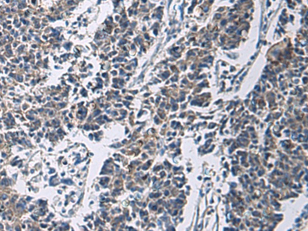 Immunohistochemistry of paraffin-embedded Human colorectal cancer tissue  using SLC30A3 Polyclonal Antibody at dilution of 1:70(?200)