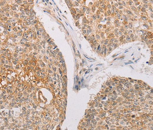 Immunohistochemistry of paraffin-embedded Human lung cancer tissue using STK40 Polyclonal Antibody at dilution 1:40