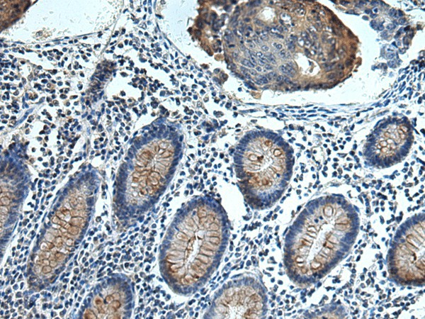 Immunohistochemistry of paraffin-embedded Human colorectal cancer tissue  using FCRLA Polyclonal Antibody at dilution of 1:80(?200)