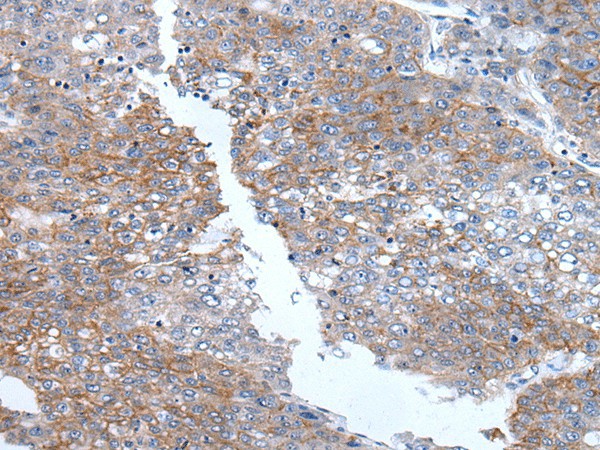 Immunohistochemistry of paraffin-embedded Human liver cancer tissue  using PRSS50 Polyclonal Antibody at dilution of 1:65(?200)