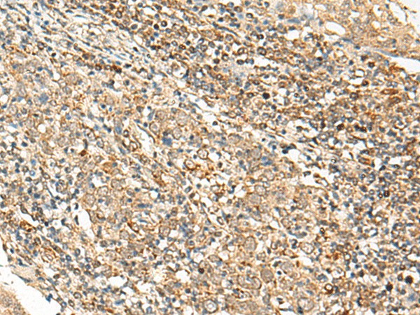 Immunohistochemistry of paraffin-embedded Human cervical cancer tissue  using SNAPC5 Polyclonal Antibody at dilution of 1:25(?200)