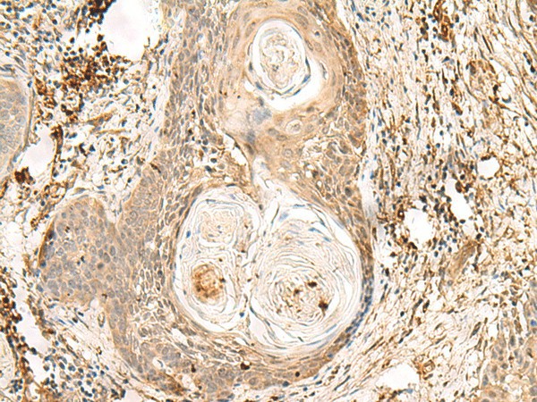 Immunohistochemistry of paraffin-embedded Human esophagus cancer tissue  using ZNF397 Polyclonal Antibody at dilution of 1:80(?200)