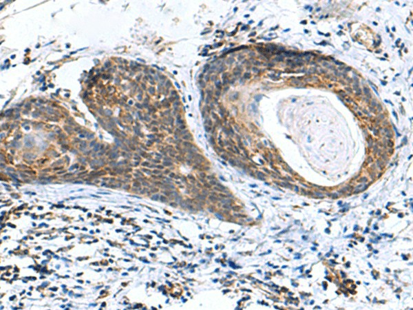 Immunohistochemistry of paraffin-embedded Human esophagus cancer tissue  using AP1S3 Polyclonal Antibody at dilution of 1:70(?200)