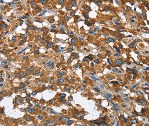 Immunohistochemistry of paraffin-embedded Human thyroid cancer using BGN Polyclonal Antibody at dilution of 1:50