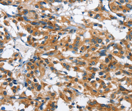 Immunohistochemistry of paraffin-embedded Human thyroid cancer tissue using BPI Polyclonal Antibody at dilution 1:50