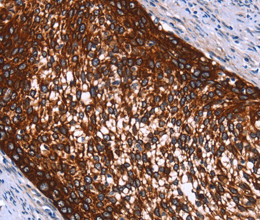 Immunohistochemistry of paraffin-embedded Human cervical cancer using HMGCS2 Polyclonal Antibody at dilution of 1:40