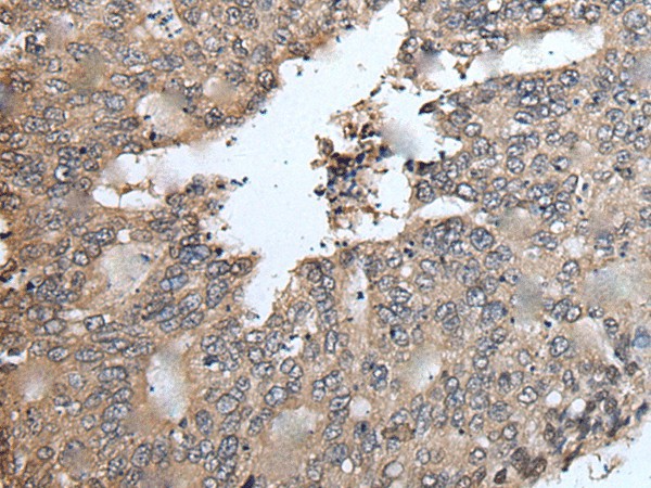 Immunohistochemistry of paraffin-embedded Human colorectal cancer tissue  using TRIM23 Polyclonal Antibody at dilution of 1:55(?200)