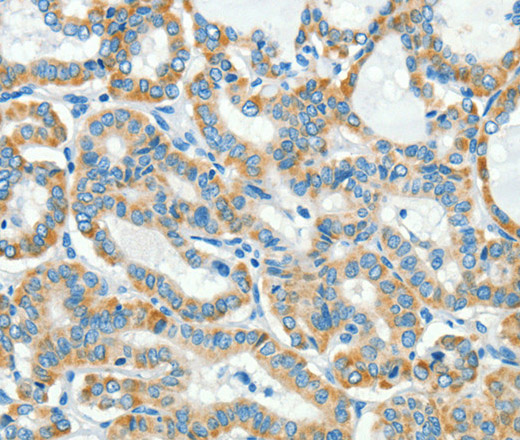 Immunohistochemistry of paraffin-embedded Human thyroid cancer tissue using L1CAM Polyclonal Antibody at dilution 1:40