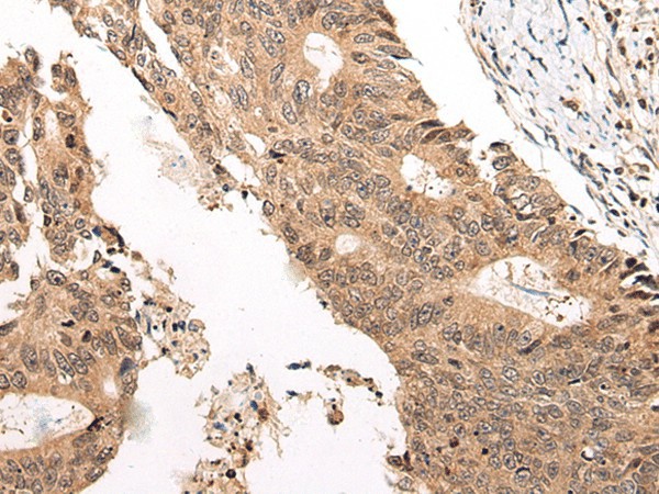 Immunohistochemistry of paraffin-embedded Human colorectal cancer tissue  using CHAMP1 Polyclonal Antibody at dilution of 1:40(?200)