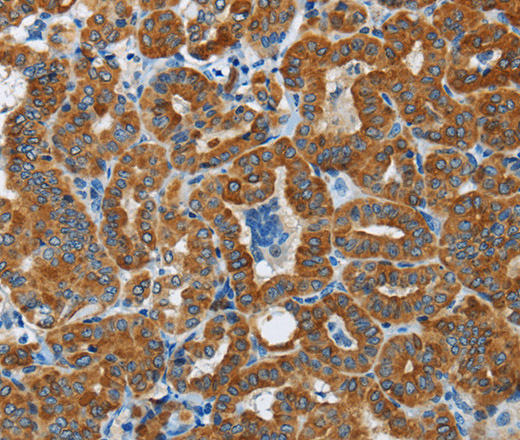 Immunohistochemistry of paraffin-embedded Human thyroid cancer tissue using FLCN Polyclonal Antibody at dilution 1:40