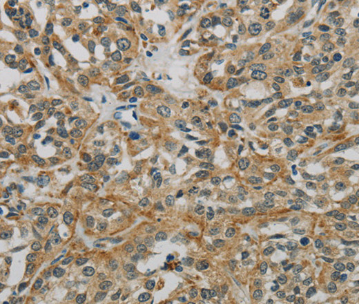 Immunohistochemistry of paraffin-embedded Human esophagus cancer using E2F6 Polyclonal Antibody at dilution of 1:60